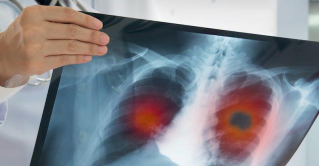 Akciğer embolisinin tedavisi neye göre belirleniyor?