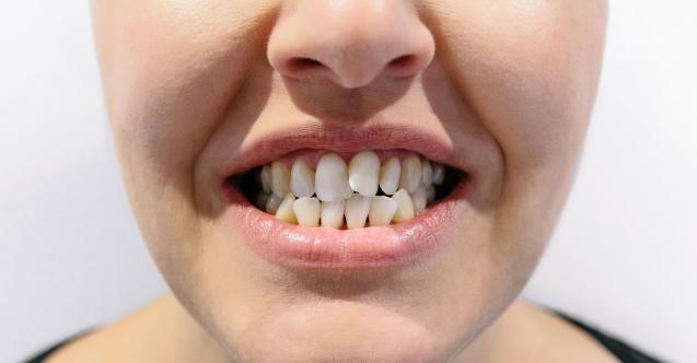 Ortodonti Tedavisi Yetişkinlere de Uygulanıyor.